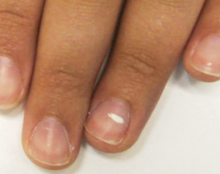 Nails with white spots like grains of rice is what disease?